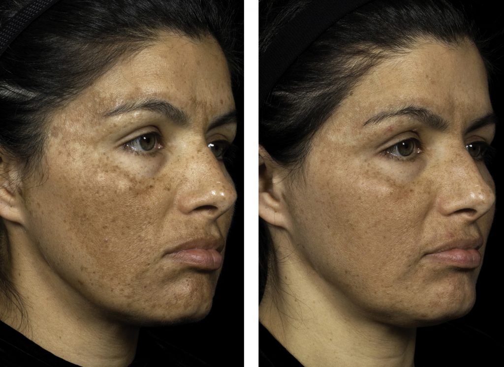 Solta Fraxel Re Fine Innovative Laser Gesichtsbehandlung Leila Beauty